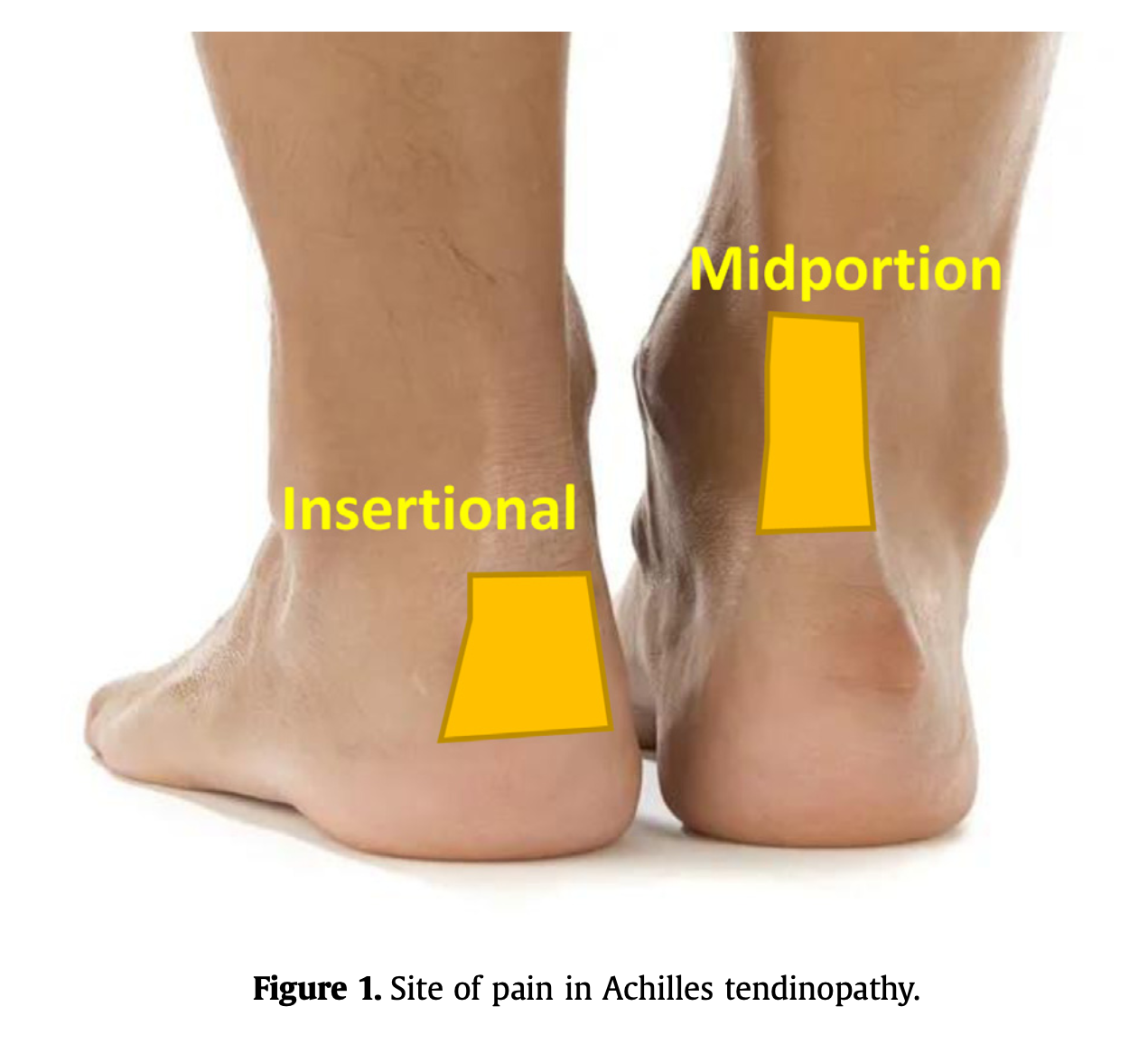 🦀 PT Crab Issue 113 - Talking Tendinopathy